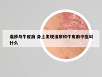 湿疹与牛皮癣 身上出现湿疹和牛皮癣中医叫什么