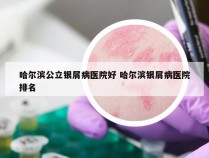 哈尔滨公立银屑病医院好 哈尔滨银屑病医院排名