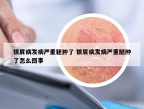 银屑病发病严重腿肿了 银屑病发病严重腿肿了怎么回事