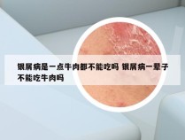 银屑病是一点牛肉都不能吃吗 银屑病一辈子不能吃牛肉吗