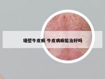墙壁牛皮癣 牛皮病癣能治好吗