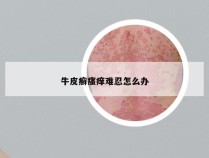 牛皮癣瘙痒难忍怎么办