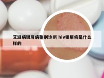 艾滋病银屑病鉴别诊断 hiv银屑病是什么样的