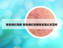 银屑病红斑鳞 银屑病红斑鳞屑就是红皮型吗