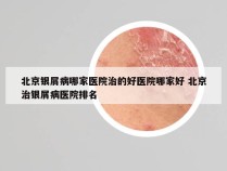 北京银屑病哪家医院治的好医院哪家好 北京治银屑病医院排名
