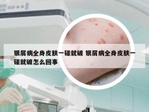 银屑病全身皮肤一碰就破 银屑病全身皮肤一碰就破怎么回事