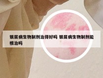 银屑病生物制剂治得好吗 银屑病生物制剂能根治吗