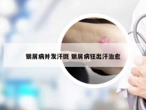银屑病并发汗斑 银屑病狂出汗治愈