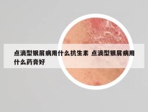 点滴型银屑病用什么抗生素 点滴型银屑病用什么药膏好