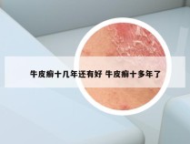 牛皮癣十几年还有好 牛皮癣十多年了