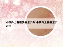 小孩身上有很多癣怎么办 小孩身上有癣怎么治疗