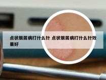 点状银屑病打什么针 点状银屑病打什么针效果好