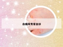白癜风专家会诊