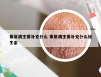 银屑病主要补充什么 银屑病主要补充什么维生素