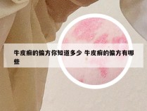 牛皮癣的偏方你知道多少 牛皮癣的偏方有哪些