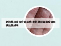 老鹳草软膏治疗银屑病 老鹳草软膏治疗银屑病效果好吗