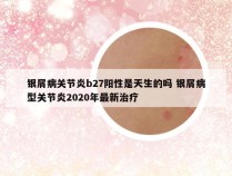 银屑病关节炎b27阳性是天生的吗 银屑病型关节炎2020年最新治疗
