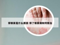 得银屑是什么原因 得了银屑病如何根治