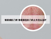 银屑病肛门疼 银屑癣在肛门的上方怎么治疗