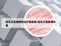 格乐立生物制剂治疗银屑病 格乐立银屑病效果