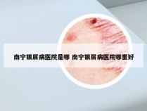 南宁银屑病医院是哪 南宁银屑病医院哪里好