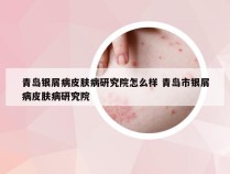青岛银屑病皮肤病研究院怎么样 青岛市银屑病皮肤病研究院