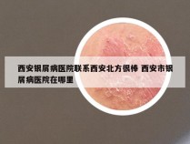 西安银屑病医院联系西安北方很棒 西安市银屑病医院在哪里