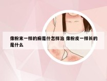 像粉末一样的癣是什怎样治 像粉皮一样长的是什么