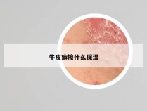 牛皮癣擦什么保湿