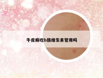 牛皮癣吃b族维生素管用吗