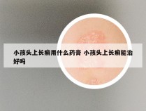 小孩头上长癣用什么药膏 小孩头上长癣能治好吗