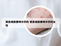 银屑病需要喝中药吗 银屑病需要喝中药吗女性