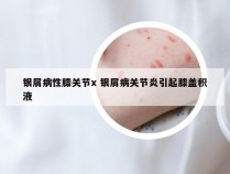 银屑病性膝关节x 银屑病关节炎引起膝盖积液