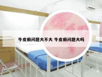 牛皮癣问题大不大 牛皮癣问题大吗