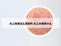 头上有癣怎么用蒜吗 头上长癣用什么