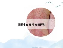 圆圈牛皮癣 牛皮癣环形