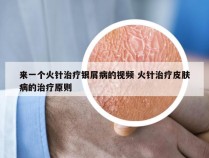 来一个火针治疗银屑病的视频 火针治疗皮肤病的治疗原则