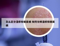 怎么区分湿疹和银屑病 如何分辨湿疹和银屑病