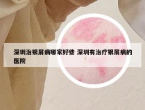 深圳治银屑病哪家好些 深圳有治疗银屑病的医院
