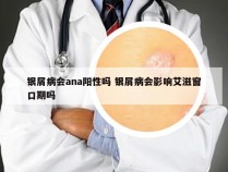 银屑病会ana阳性吗 银屑病会影响艾滋窗口期吗