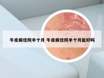 牛皮癣住院半个月 牛皮癣住院半个月能好吗