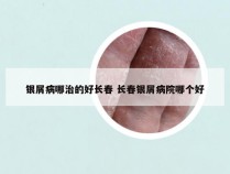 银屑病哪治的好长春 长春银屑病院哪个好