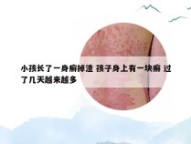 小孩长了一身癣掉渣 孩子身上有一块癣 过了几天越来越多