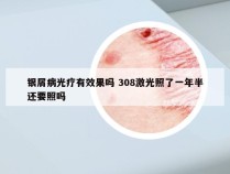 银屑病光疗有效果吗 308激光照了一年半还要照吗
