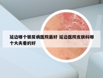 延边哪个银屑病医院最好 延边医院皮肤科哪个大夫看的好