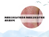 胸腺肽注射治疗银屑病 胸腺肽注射治疗银屑病效果好吗