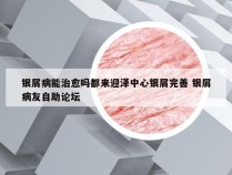 银屑病能治愈吗都来迎泽中心银屑完善 银屑病友自助论坛