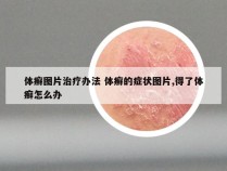 体癣图片治疗办法 体癣的症状图片,得了体癣怎么办