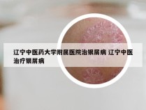 辽宁中医药大学附属医院治银屑病 辽宁中医治疗银屑病