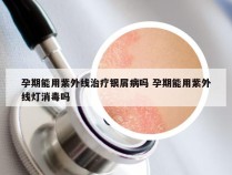 孕期能用紫外线治疗银屑病吗 孕期能用紫外线灯消毒吗
